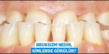 Bruksizm nedir, kimlerde görülür?