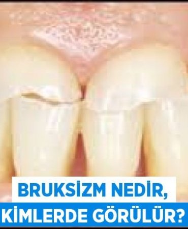 Bruksizm nedir, kimlerde görülür?